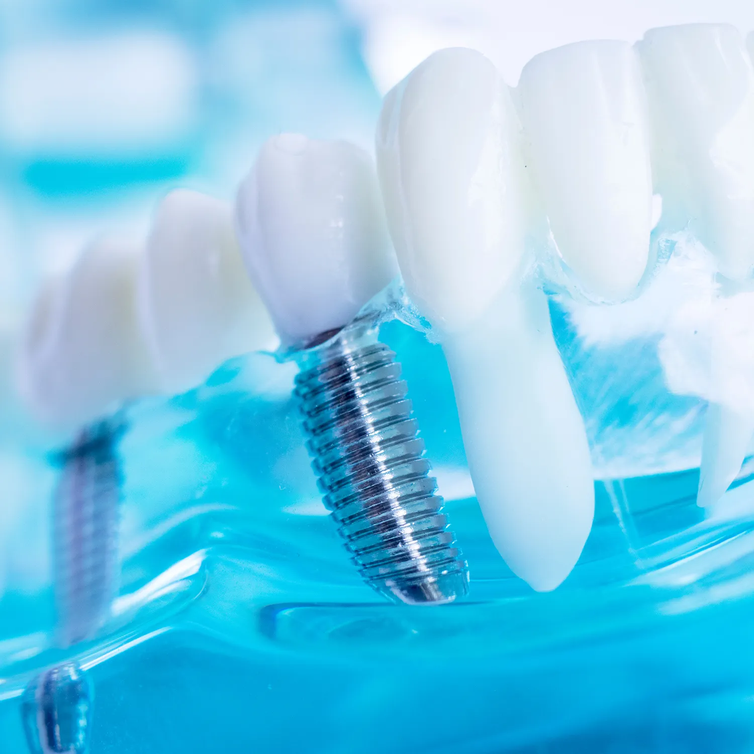 Implantologia, Centro Dental Smile Oristano