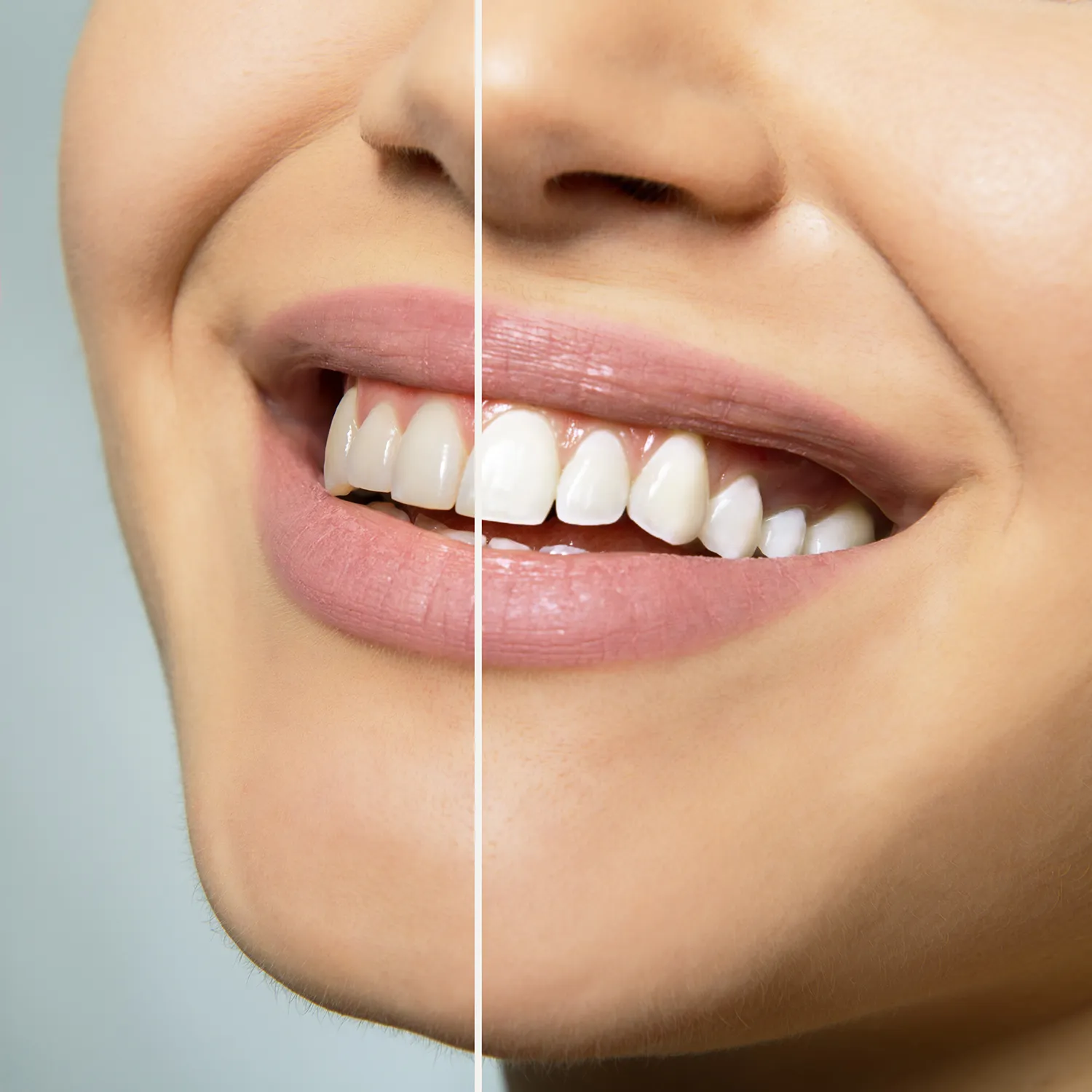 Sbiancamento Dentale, Centro Dental Smile Oristano