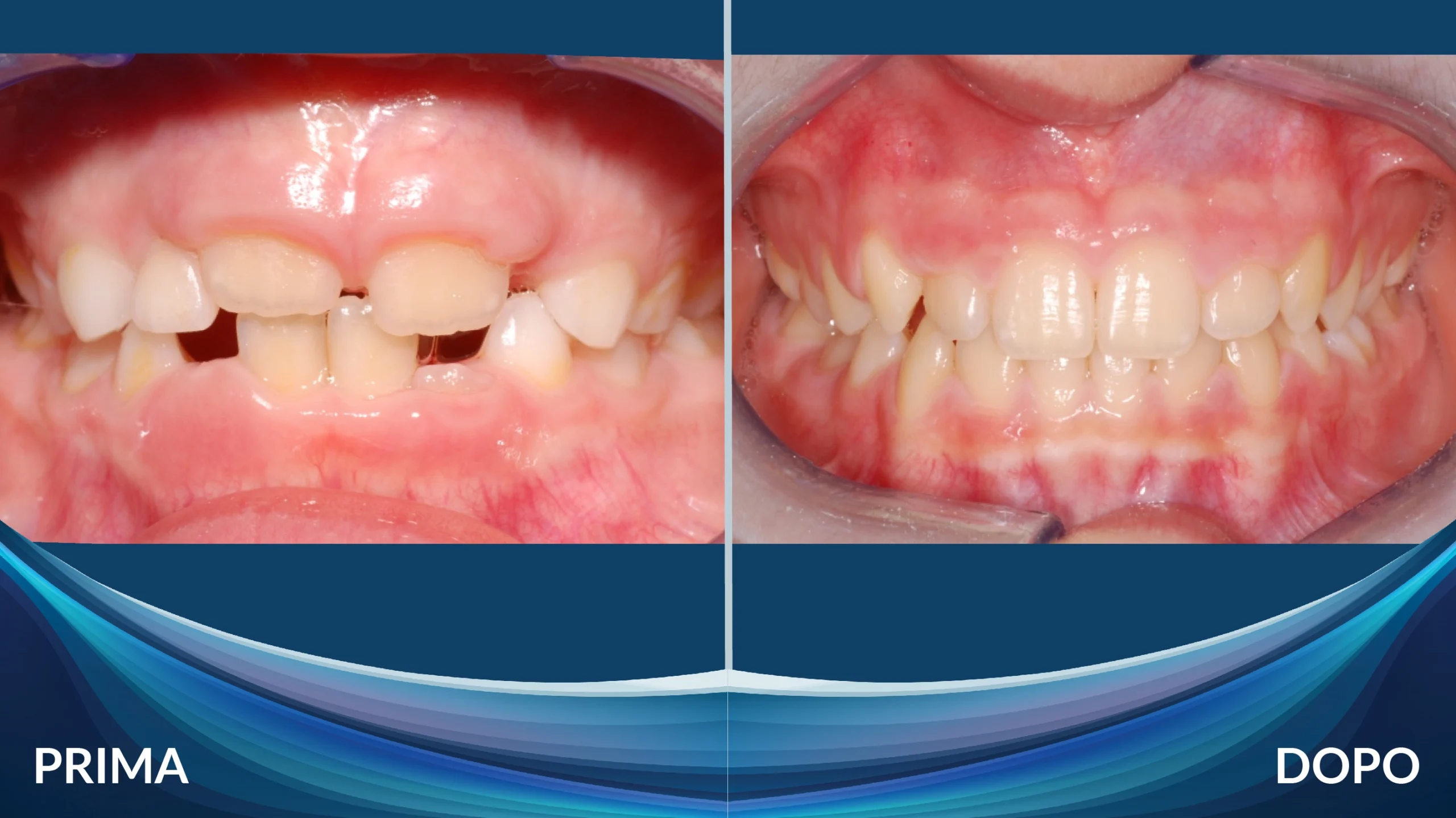 Prima e dopo ortodonzia intercettiva su bambino - Caso 1, Centro Dental Smile Oristano