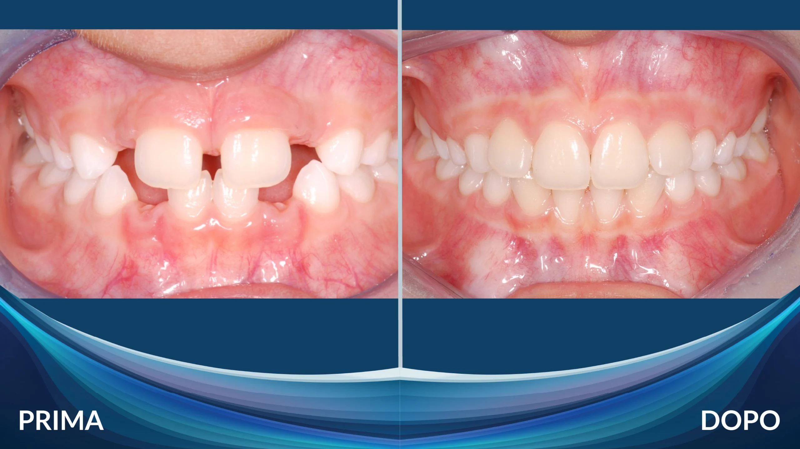 Prima e dopo ortodonzia intercettiva su bambino - Caso 2, Centro Dental Smile Oristano