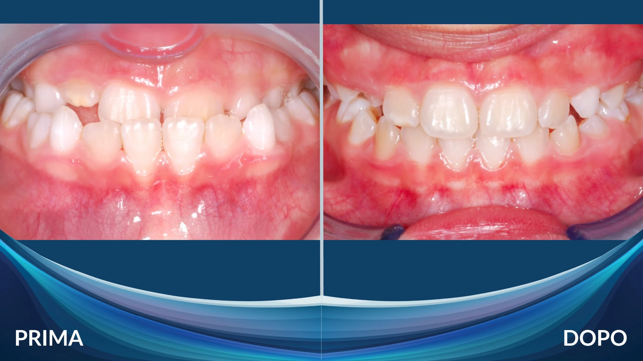 Prima e dopo ortodonzia intercettiva su bambino - Caso 3, Centro Dental Smile Oristano