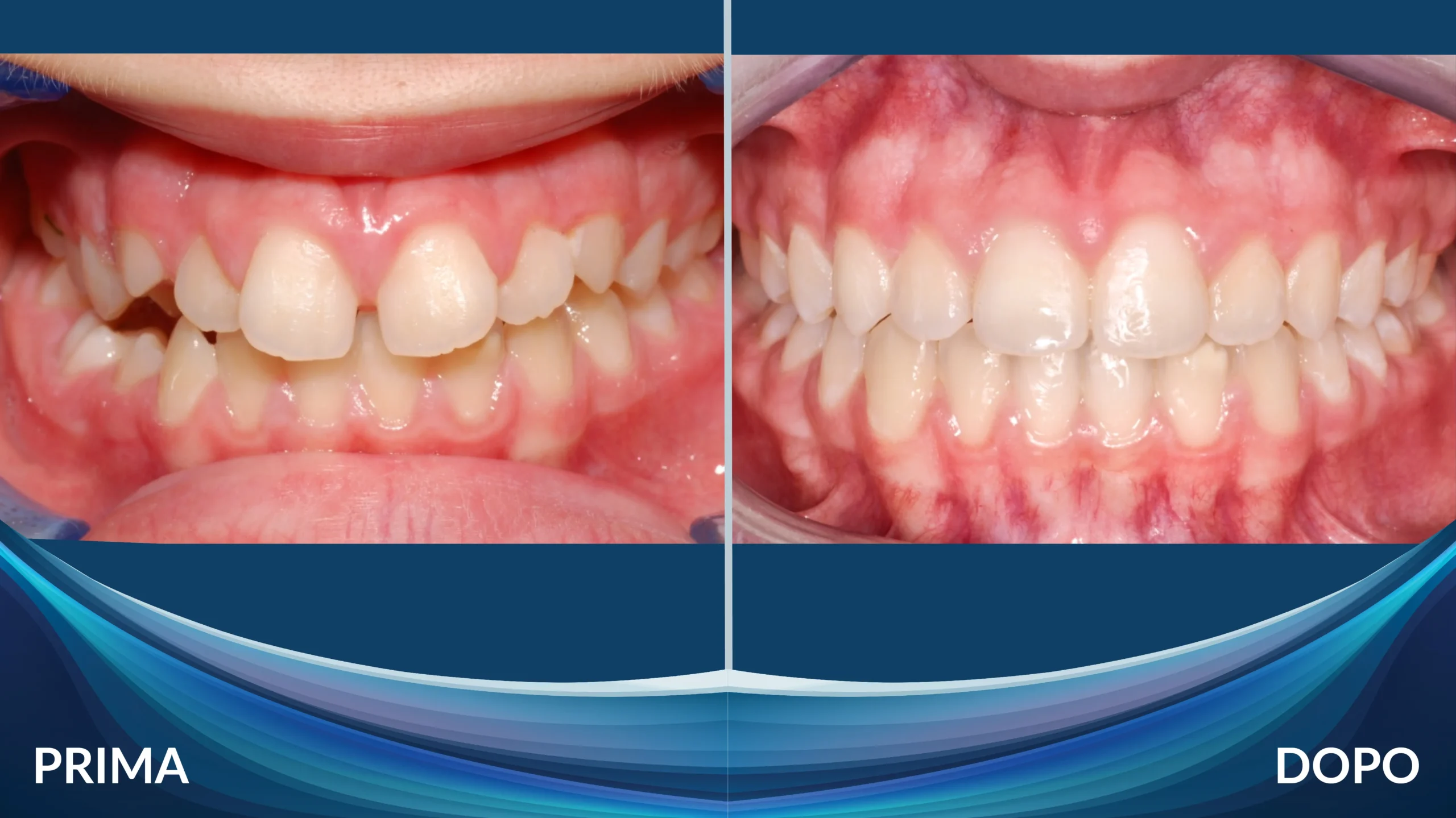 Prima e dopo ortodonzia intercettiva su bambino - Caso 4, Centro Dental Smile Oristano